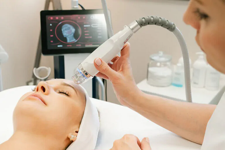 Radiorefraktiivinen mikroneula Rf nosto ilman päänahkaa